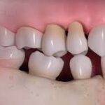 What Happens If You Don’t Replace Missing Teeth?