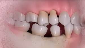 What Happens If You Don’t Replace Missing Teeth?